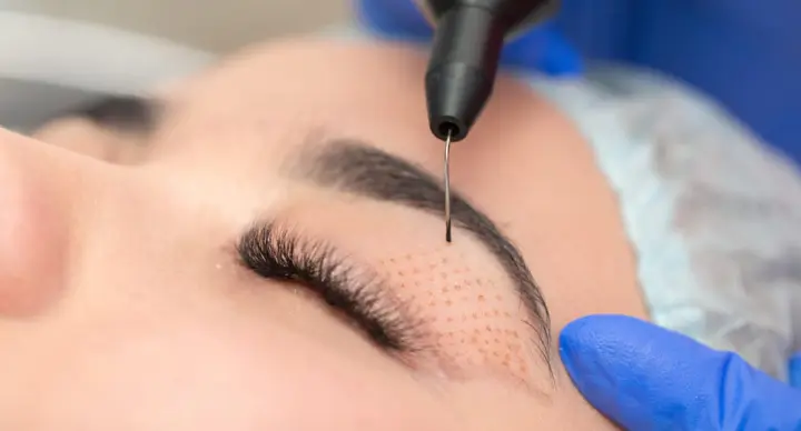 Plasmage: blefaroplastia sin cirugía