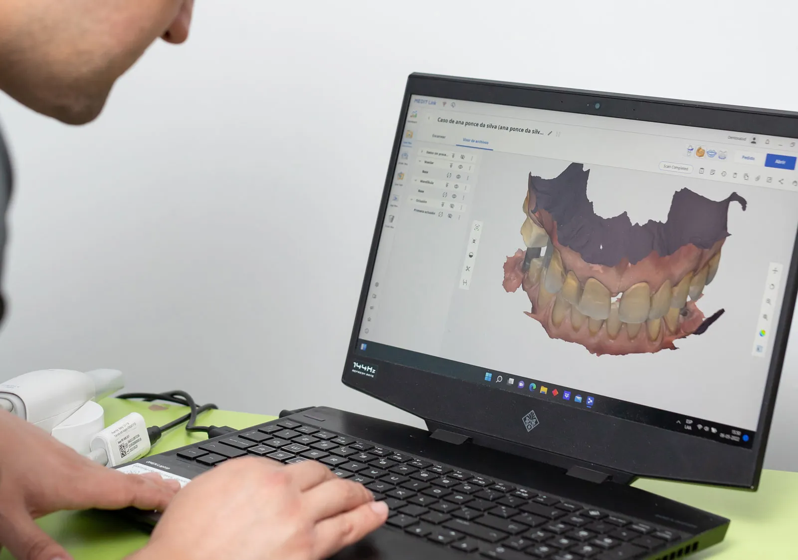 Escáner intraoral 3D de Dentosalud